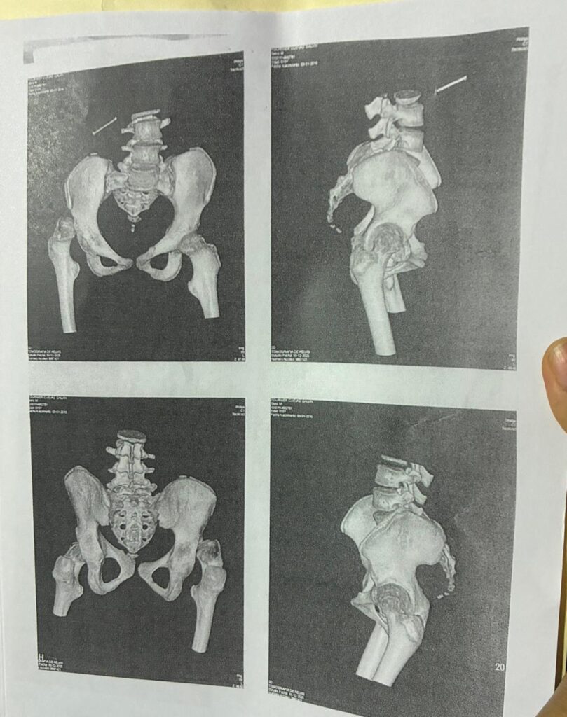 Madre solicita ayuda para costear cirugías de su hijo con parálisis cerebral | 1 | Madre solicita ayuda para costear cirugías de su hijo con parálisis cerebral - Noticias de hoy en República Dominicana | De Último Minuto
